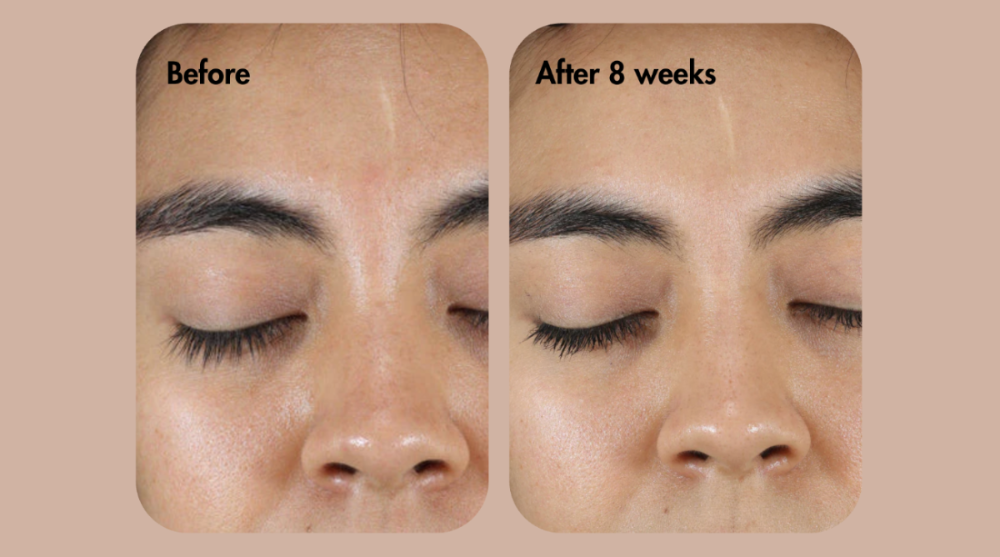 Comparaison avant et après d'un traitement des sourcils sur le visage d'une personne.